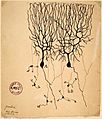A drawing on yellowing paper with an archiving stamp in the corner. A spidery tree branch structure connects to the top of a mass. A few narrow processes follow away from the bottom of the mass.