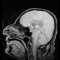 NPH MRI 272 GILD