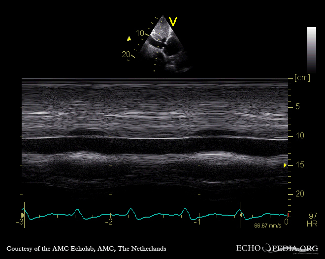 Severe tricuspid regurgitation E00572 (CardioNetworks ECHOpedia)