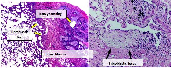 Photomicrograph of usual interstitial pneumonia