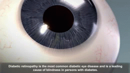 Diabetic retinopathy-NIE