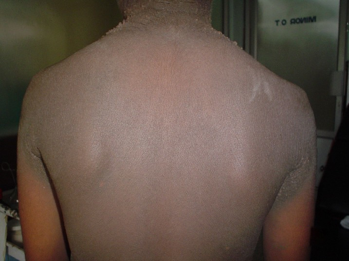 Familial acanthosis nigricans2