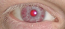Red (albino) eye