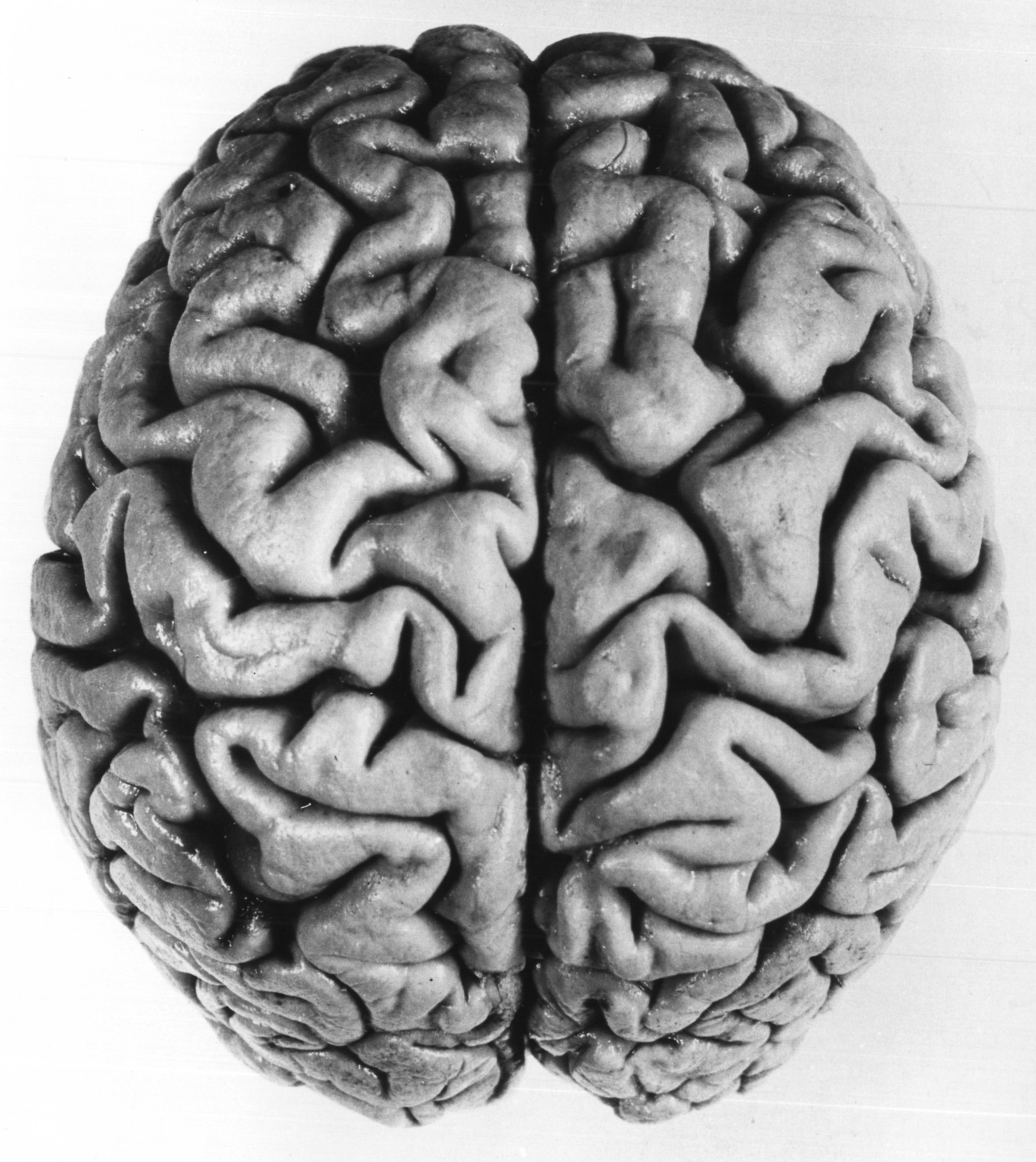 A human brain showing patterns of ridges and grooves.