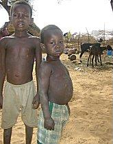 Niger childhood malnutrition 16oct06