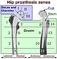 Hip prosthesis zones by DeLee and Charnley system, and Gruen system