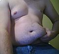 Excess abdominal fat