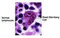 Reed-Sternberg lymphocyte nci-vol-7172-300
