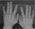 Syndactyly type1 hands