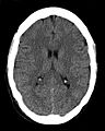 Brain CT scan