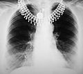 Chest X-ray 1300274 cr