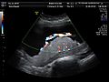 Human placenta umbilical cord Ultrasound by Dr. W. Moroder