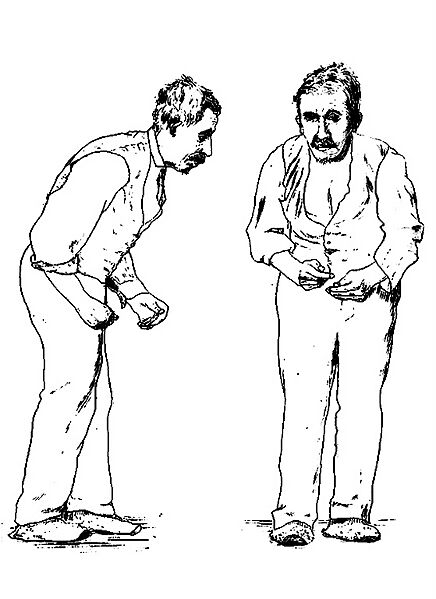 Parkinson’s disease 1880s