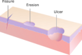 Ulcers, fissures, and erosions