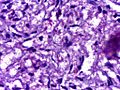Leprosy - Lepromatous (LL) Wade Fite stain