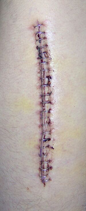 Cdm hip staples 376