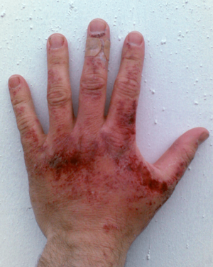 Sodium hydroxide burn