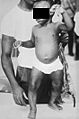 Child suffering from rickets