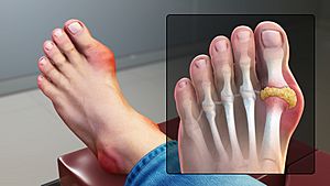 Gout Signs and Symptoms