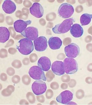 Acute leukemia-ALL