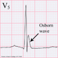Osborn wave