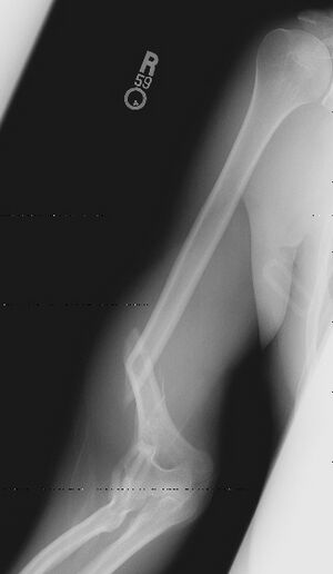 Arm-Wrestle-Xray