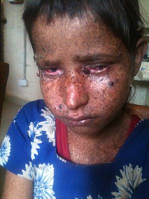 Child suffering from Xeroderma Pigmentosum in Rukum,Nepal