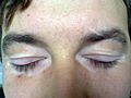 Eyelid vitiligo 06