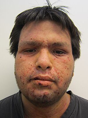 Impetigo2011