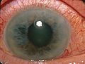 Acute Angle Closure-glaucoma