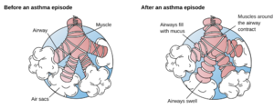 Asthma before-after-en