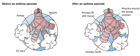 Asthma before-after-en