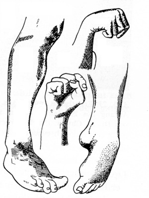 Convulsivus005