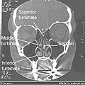 NormalNose-CT-Front-cross-section-common-wiki