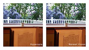 Hyperopia comparison