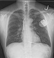 Implantable cardioverter defibrillator chest X-ray