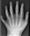 Polydactyly 01 Lhand AP