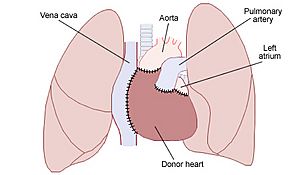Heart transplant
