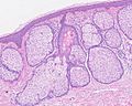 Histopathology of sebaceous hyperplasia