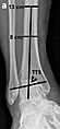 X-ray of frontal tibiotalar surface angle (TTS)