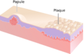 Papule and Plaque