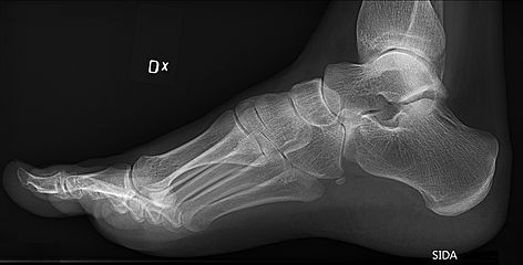 Pes cavus and os peroneum on lateral foot X-ray