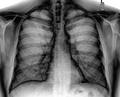 Chest Xray PA 3-8-2010 inverted