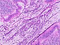 Histopathology of acute intraluminal inflammation of the appendix