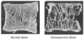 Bone Comparison of Healthy and Osteoporotic Vertibrae