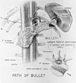 Path of Bullet that wounded President James A. Garfield - Duncan K. Winter drawing - NCP 001860