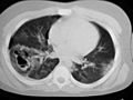 Pulmonary contusion pseudocyst CT