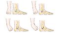 Ankle sprain -- Smart-Servier (cropped)