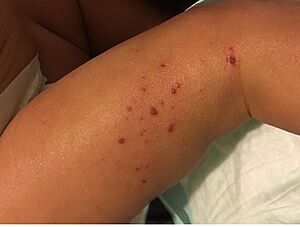 Child with Eczema (34034003933)