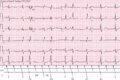 Sinus rhythm with 3-to-2 and 2-to-1 Type II A-V block